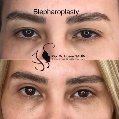 Mid-facial lifting Before / After photo